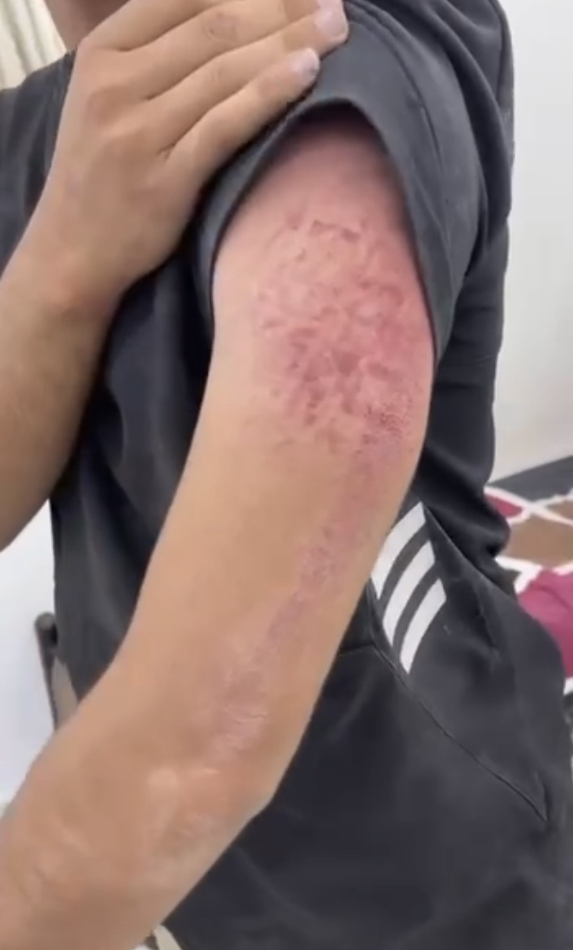 فيديو| آثار اعتداء جنود الاحتلال على شاب وتخريب محتويات منزله بعد اقتحامه في بلدة يعبد جنوب غرب جنين....