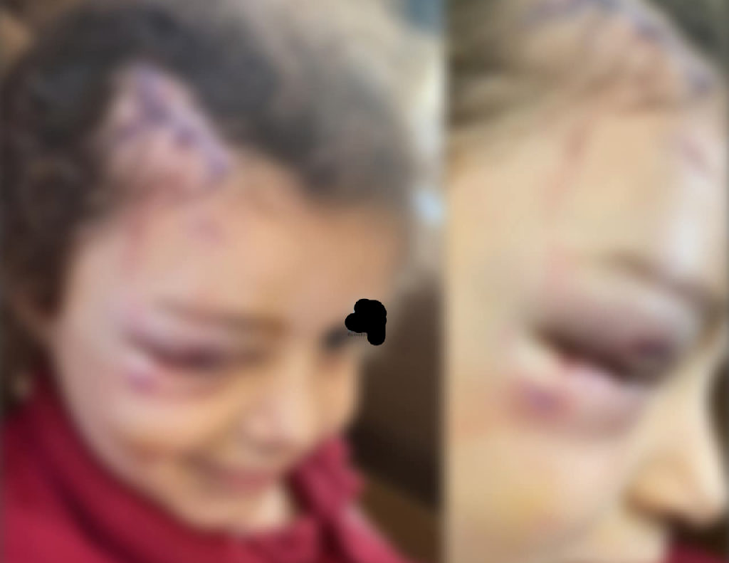 هذه الطفلة  من قرية بزاريا قضاء نابلس تعرضت اليوم لهجوم صعب من قبل كلب ضال , اصيبت الطفلة في رأسها وفي عينها , اثناء تواجدها امام منزلها , هذه الظاهرة...